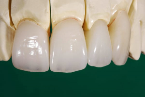 Những gì cần biết về răng toàn sứ Zirconia Ddbio
