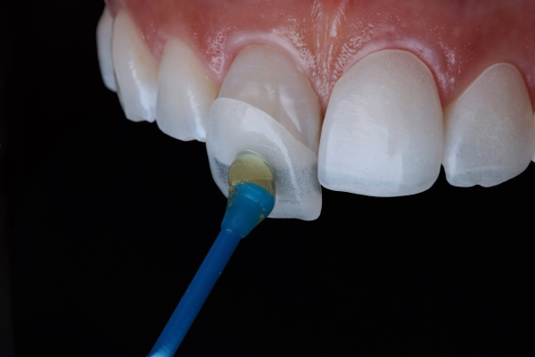 Phủ răng sứ Veneer là gì?