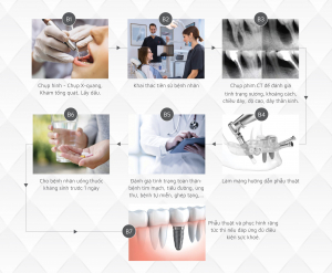 Kỹ thuật Implant All On | Phục hồi răng mất hiệu quả