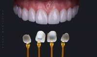 Nên bọc răng sứ bằng phương pháp nào?