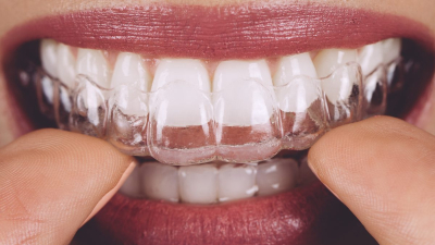Tại sao niềng răng mắc cài trong suốt luôn được ưa chuộng?