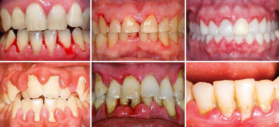 Chương trình thu hồi răng sứ cũ đổi răng sứ mới tại ST Dentist