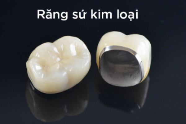 Trồng răng sứ kim loại có tốt không?