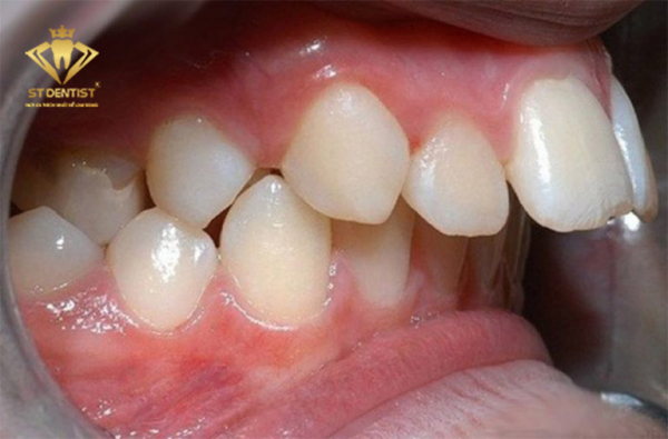 Lột xác với phương pháp niềng răng hô