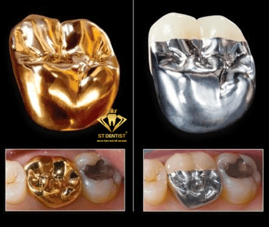 Răng sứ kim loại có hiệu quả phục hình tốt hay không?