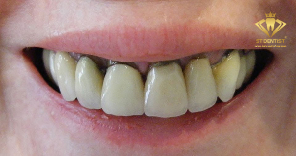 Răng sứ kim loại có hiệu quả phục hình không?
